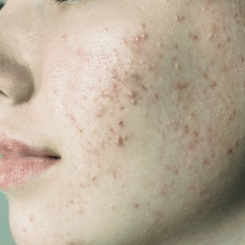 Acne in Teenagers & Adults img