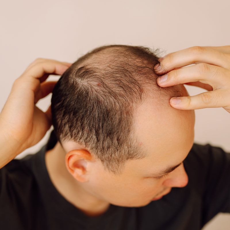Hair Loss & Scalp Conditions