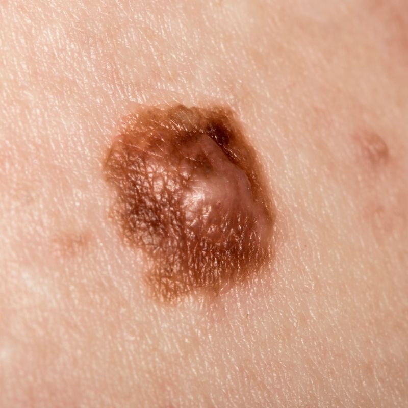 Mole Early Assessment Matters