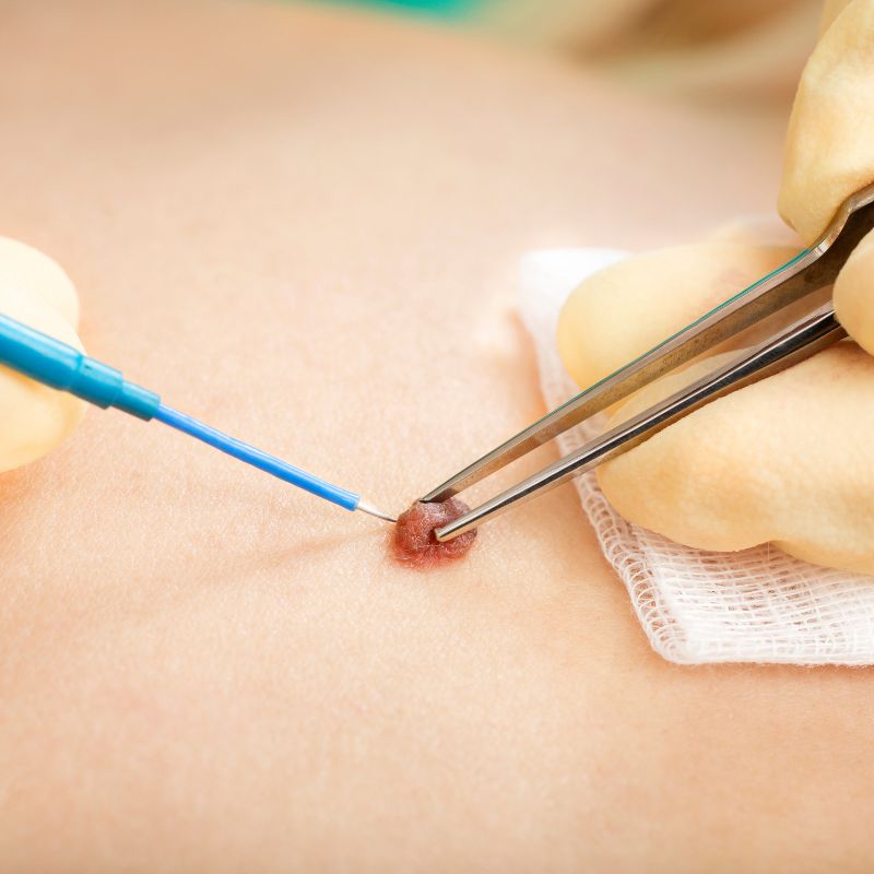 Mole Removal & Histopathology