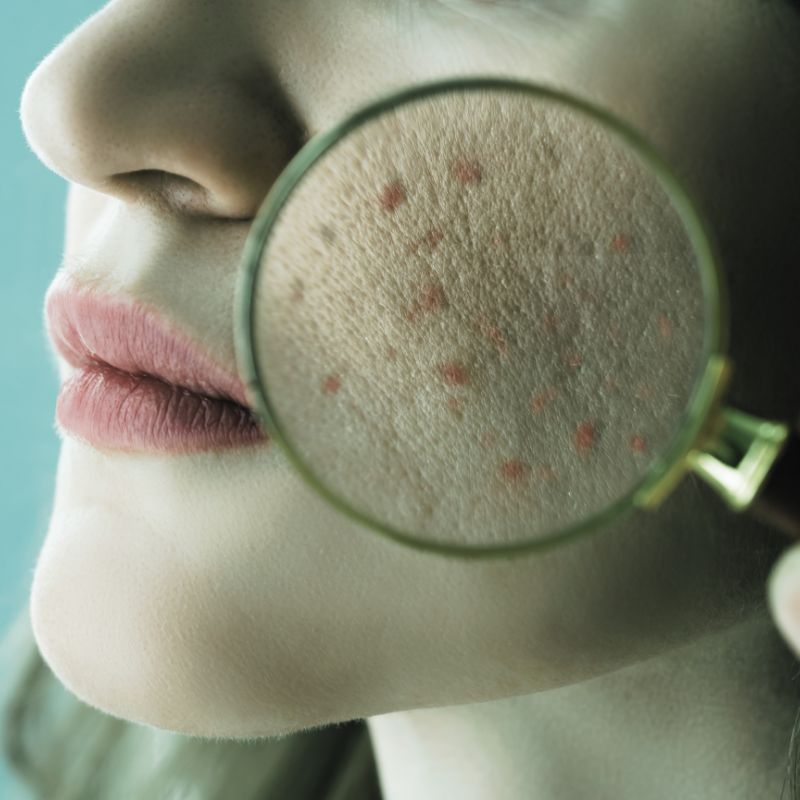 Professional Acne Assessment & Treatment Professional Acne Assessment & Treatment
