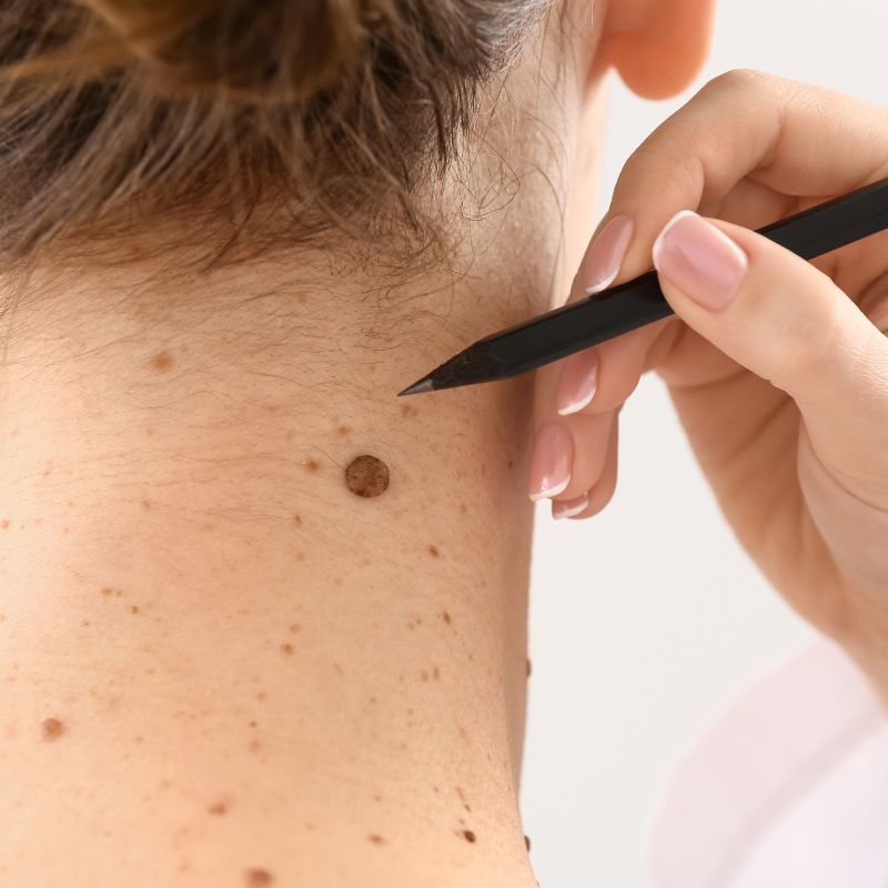 Removal of Moles