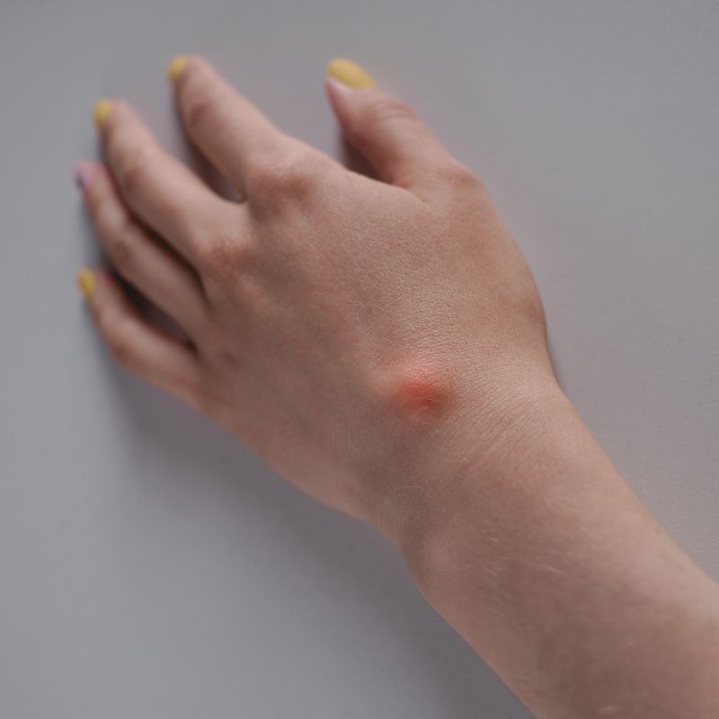 Skin Cysts img