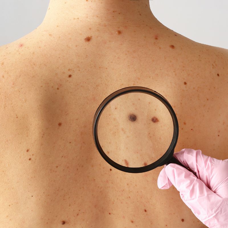 What a Mole Check Is For